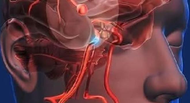 Aneurysm: Signs You Shouldn’t Ignore