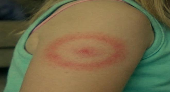 My Daughter Woke Up With a Strange Red Ring on Her Arm: A Parent’s Guide to Ring-Shaped Rashes (And When to Breathe Easy)