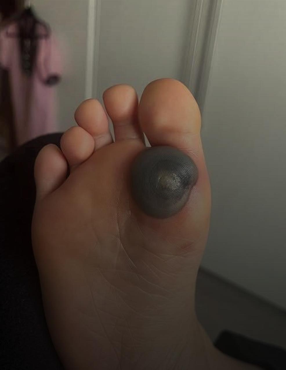 My Daughter Woke Up With This Huge Spot On Her Foot