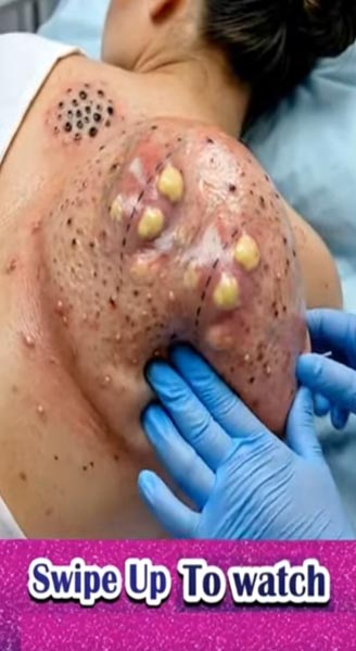 Massive Back Lipoma