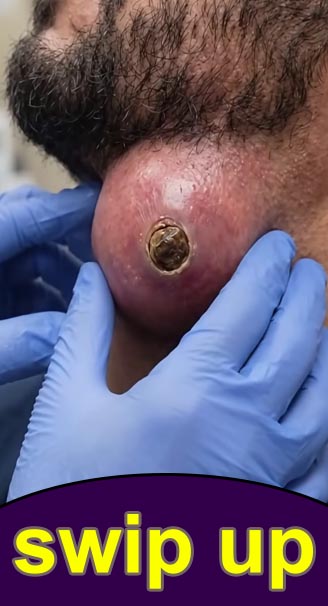 Why Acne Appears on These 8 Body Areas, and What You Should Do